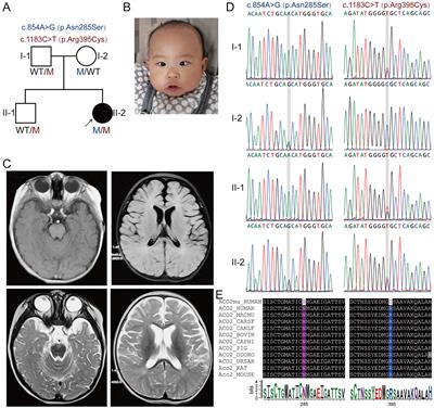 Transcriptome analyses reveal molecular mechanisms of novel compound heterozygous ACO2 variants causing infantile cerebellar retinal degeneration